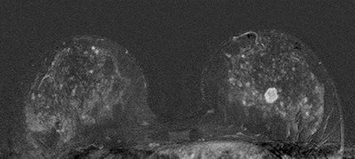 breast MRI