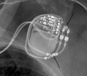 A pre-MRI x-ray allows visual confirmation of electrode placement and integrity, implantable pulse generator position, and MR-conditional radiopaque markers. Top arrow indicates radiopaque emblem of an MR-conditional pacemaker. Bottom arrow indicates appropriate electrodes or 'leads' with MR-conditional wavy radiopaque markers. Image courtesy of Dr. Josef Vymazal.