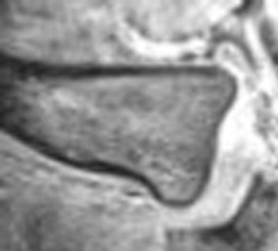 Stage III (left): In this early stage III, there is a hypointense ossification center, which is connected to the diaphysis by hyperintense cartilage, and a very small bony bridge, visible as a thin hypointense line between the epiphysis and the diaphysis. This small bony bridge is invisible on plain radiography. Stage V (right): Mature medial end of the clavicle. The ossification center has completely fused with the diaphysis, and the growth plate is invisible. All images courtesy of Elke Hillewig and Dr. Koenraad Verstraete.