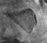 3T MRI of clavicle
