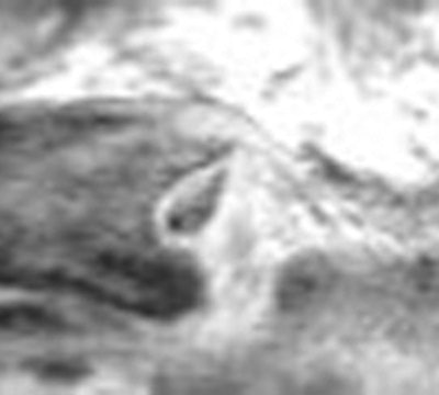 High-resolution 3-tesla MR images of the medial part of the right clavicle. Stage I (left): There is no ossification center and the epiphysis is completely cartilaginous (high signal intensity). Stage II (right): There is a hypointense ossification center, which is connected to the diaphysis by hyperintense cartilage, without bony bridges.