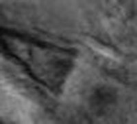 3T MRI of clavicle