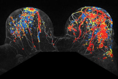 CAD can identify maximum intensity projection when paired with MRI. However, the radiologists' interpretation is still important. Image courtesy of Dr. Monique Dorrius.