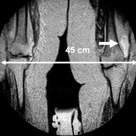 T2-weighted, turbo spin-echo MR image with a field-of-view of 45 cm. The clinical findings of the excessively obese patient included pain in the left knee and laboratory values indicative of inflammation. MR depicted a hyperintense signal in the soft tissue lateral to the left femur condyle (white arrow). The soft-tissue abscess was confirmed by microbiology. Image courtesy of Dr. Maximilian de Bucourt.