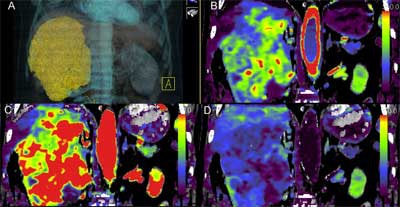 Helical perfusion CT depicting a renal tumor acquired at 100 kV. Images show 3D image (A), B) blood flow (B), blood volume (C), and flow-extraction product (D). Images courtesy of Dr. Vicky Goh.