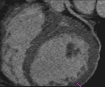 Images of a 65-year-old male patient acquired in dual-source CT high-pitch mode show good enhancement of the coronary arteries down to their distal portions. Top image shows calcified stenosis at the origin of the proximal portion of the left anterior descending (LAD) artery.Bottom image depicts the left circumflex (LCX) artery, and an absence of atherosclerotic lesions. The acquisition consisted of a whole-chest CT angiography exam obtained without beta blockers or electrocardiac gating. All images courtesy of Dr. Martine Rémy-Jardin.