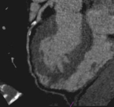 Dual Source Ct Scan Of 65 Year Old Male