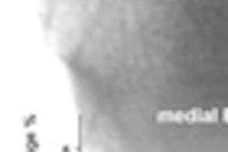 2011 04 29 09 24 33 771 2011 04 29 Knee Oa Image Thumb2