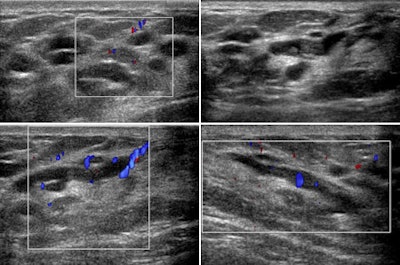Patient presented with spontaneous, brown, right nipple discharge that had lasted for one year. Personal history, physical examination, mammography and ultrasound (images above) revealed only benign findings (bilateral fibroadenomas and duct ectasia in the outer quadrants of the right breast). During cytological analysis of secretion material, a papillary lesion without atypia was found. All images courtesy of Dr. Michele Lorenzon.