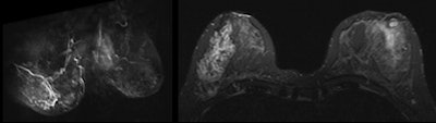 Breast MRI showed a suspicious non-mass-like enhancement in the inferior-outer quadrant of the right breast, occupying approximately 50 mm in the axial plane. The final pathological diagnosis was papillary carcinoma with extensive intraductal carcinoma.