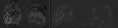 Breast MRI showed a suspicious non-mass-like enhancement in the right breast