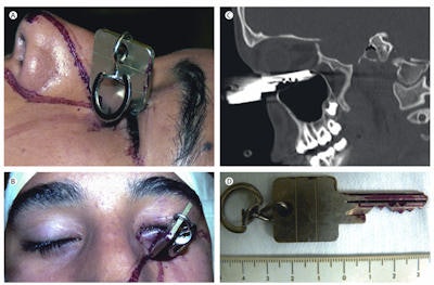 Images Of A Football Injury To The Eye