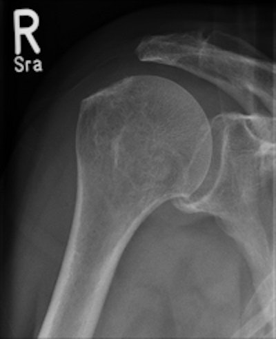 Wireless digital radiography (DRX-1) is faster and produces higher quality bone studies than conventional radiography, according to a study presented at the 2011 ECR. Conventional radiography image is at left, while wireless DRX-1 image is at right. Images courtesy of Dr. Thomas Lehnert.
