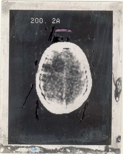 Polaroid image of the first clinical CT scan
