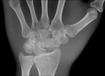 Two images of a hand phantom obtained using different equipment: Fuji's CR system and DRX-1 from Carestream. All images courtesy of Dr. Thomas Lehnert.