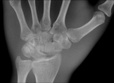 A third image of a hand phantom obtained using DR9500 from Carestream.