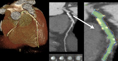 2011 05 17 15 58 08 575 Otton calciumscoring top