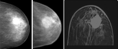 Clinical example of image registration of conventional mammography with high-field MR mammography at 3 tesla. Left, craniocaudal conventional mammography. Middle, virtual craniocaudal mammography. The latter was calculated by the registration software based on the 3D MR mammography dataset. In the image on the right, an exemplary axial view is shown, covering the central part of the advanced enhancing mass (first minute after Gd-DTPA). Histological verification after imaging revealed invasive ductal carcinoma. Images courtesy of Dr. Matthias Dietzel.