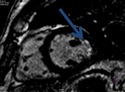 Late gadolinium enhancement image shows a small subendocardial lateral myocardial infarction (blue arrow).