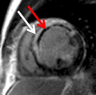 Late gadolinium enhancement image shows a large anteroseptal myocardial infarction (white arrow) with a central core of microvascular obstruction (red arrow). Images courtesy of Dr. Mark Westwood.