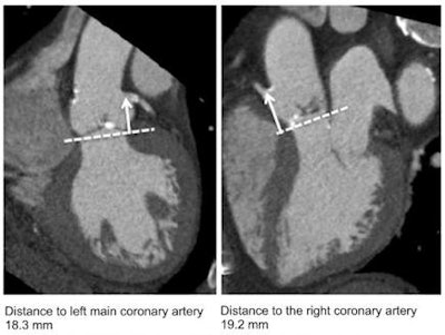 Images provided by Dr. Victoria Delgado, PhD, Leiden University Medical Center, the Netherlands, from her presentation 'CT for Coronary and Structural Heart Disease' at EuroPCR 2011.