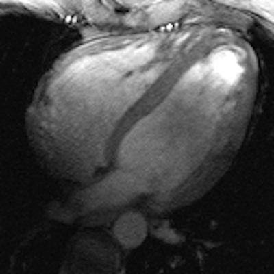 Cine image of the beating heart: four-chamber view