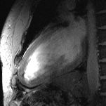 Cine images (left: four-chamber view, middle: short-axis view, right: two-chamber view) of the beating heart acquired with a novel 16-channel transmit/receive radiofrequency coil array at 7.0 tesla with an in-plane resolution of 1 x 1 mm2 and a slice thickness of 4 mm. Images courtesy of Dr. Thoralf Niendorf.