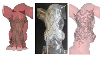 Implantation of a new percutaneous pulmonary valve device into a dilated pulmonary artery. Left: Virtual implantation on the computer. Middle: Implantation into a rapid prototyping model. Right: 3D CT image following actual device implantation. Note the excellent prediction of the device position following the trial implantation into the rapid prototyping model. Images courtesy of Dr. Andrew Taylor.