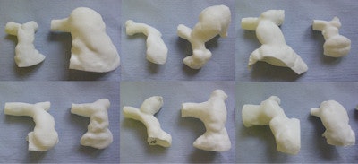 3D models of the pulmonary arteries built from MRI data from 12 adult patients with Tetralogy of Fallot, who all underwent repair during infancy. Note the huge range in anatomy that develops over time.