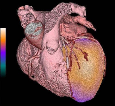 PET/CT angiogram fusion image comprises a volumetric CT angiogram showing the structure of the heart and vessels in pink. A color flow map is superimposed on the left ventricle derived from the PET images. Gold is good myocardial blood flow, while purple is reduced flow. The combined imaging shows that distal to a LAD stent, there is flow limitation (purple color toward the apex of the left ventricle).