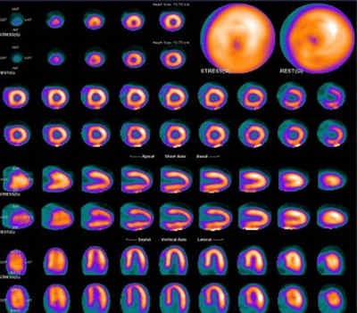 Rubidium PET myocardial perfusion study shows that even during cardiac stress, there is no inducible ischemia. Images courtesy of Dr. Ashley Groves.