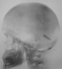 Bullet in the brain
