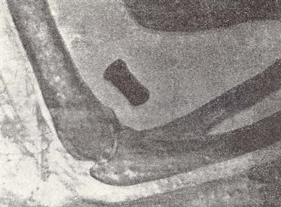 The illustration shows a radiograph of a bullet in the elbow of a native soldier taken by Maj. Beevor.