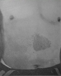 The abdomen of Walter Booth with an x-ray burn.