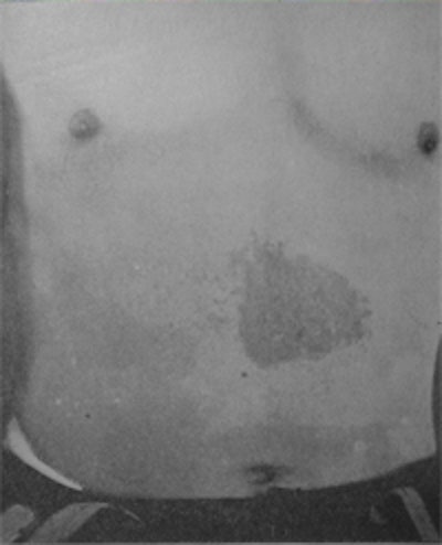 The abdomen of Walter Booth with an x-ray burn.