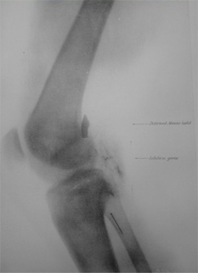 Private John Gretzer (left) received a bullet in his brain, which an x-ray detailed. Illustrated is a Mauser bullet in in the brain of John Gretzer (center) and the knee of Samuel Davis (right).