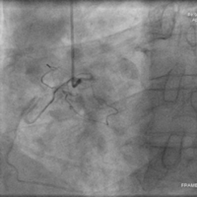 Same patient as above. Left: A conventional left coronary angiogram confirming the CT findings. Right: A conventional right coronary angiogram confirming findings.