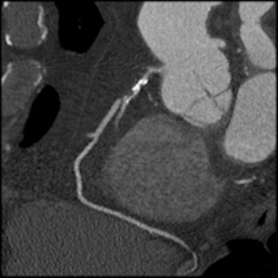 Image series shows comparison images demonstrating how high-definition CTA improved reporting accuracy. Case is a 49-year-old man with previous stent to the circumflex artery with recurrent pain. Left: Image shows a stent in the circumflex artery but no stenosis. Right: Image shows an occluded right coronary. All images courtesy of Dr. Carl Roobottom.