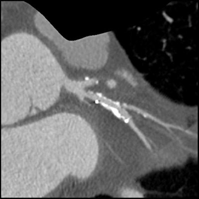 Same patient as above. Image shows the circumflex but demonstrates how use of the Discovery HD750 scanner allows clear visualization of the short stenosis despite the stent and high level of calcium in the arteries.