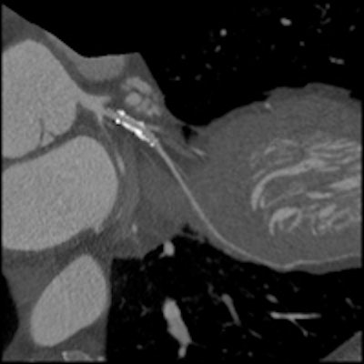 A stent in the circumflex artery but no stenosis