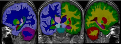 Segmentation of brain images is often a prerequisite for quantitative analysis of images. Image courtesy of Dr. Jyrki Lötjönen.