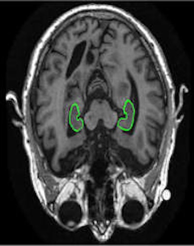 Left: Regions showing severe atrophy for an Alzheimer's patient during a 24-month follow-up period. Right: The size of the hippocampus is a well-known biomarker in Alzheimer's disease. The green contours show the automatic segmentation result of the hippocampi. Image courtesy of Dr. Jyrki Lötjönen.