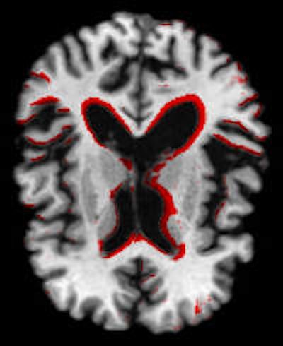 Regions showing severe atrophy for an Alzheimer's patient during a 24-month follow-up period