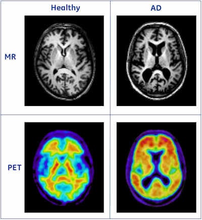 Upper row shows MR images from a healthy person and a patient with Alzheimer's disease (AD). The right image shows clear signs of atrophy. The lower row shows PET images acquired with the amyloid imaging agent [F18]flutemetamol. The left image shows low uptake in the cortical regions, indicating no presence of amyloid plaques, while the right image shows high uptake in the cortical regions. The information from these modalities is complementary; the PET image shows information related to the underlying AD pathology, whereas the MR image shows information related to neuronal loss, a downstream effect of the disease. [F18]flutemetamol is a compound under development, and the data are from the Phase II trial). Image courtesy of Lennart Thurfjell, PhD.
