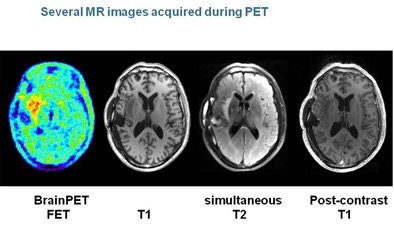 Brain PET