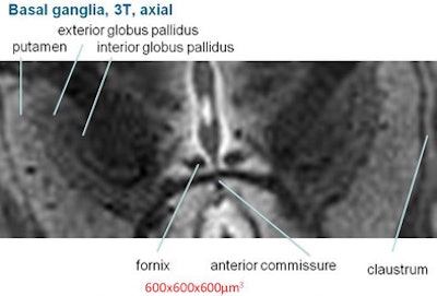 Basil ganglia image at 3 tesla (above) does not achieve the clarity, sharpness, and contrast of the image obtained at 9.4 tesla (below).