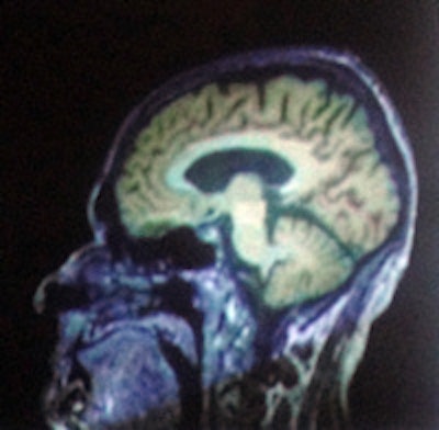 MP-RAGE T1 image of a brain tumor combined with a PET image by F-fluoroethyl-tyrosine (FET). All images are courtesy of N. Jon Shah, PhD.