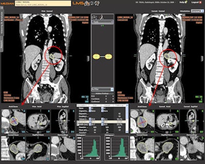 Computer-assisted follow-up exam of chemotherapy patient comparing prior and current coronal views. Changes to the target tumor are displayed and measured in an axial zoom view. Image courtesy of Median Technologies.