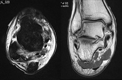 A 24-year professional football player is tackled from the side. The player feels immediate pain in the ankle and is taken off the pitch on a stretcher. Swollen and bruised medial and lateral ligaments and a complex inversion/eversion injury on the fixed foot are apparent. MRI shows grade II lateral and medial ligament injury. Full thickness anterior talofibular ligament tear, partial thickness calcaneofibular ligament tear, full thickness superficial deltoid, and partial thickness deep deltoid can be seen. MRI is the optimal test for integrity of medial and lateral ligaments, but if bony injury is present, CT may be necessary.