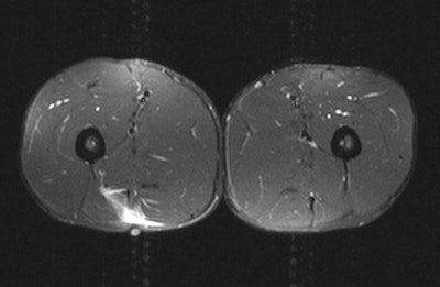 A 28-year-old male sprinter felt sudden onset of posterior thigh pain during a sprint. Swelling, tenderness, and reduced strength were evident. MRI showed grade II myotendinous strain of the long head of biceps muscle, and grade I myotendinous strain of the right rectus femoris muscle associated with scarring of the central tendon. The prognostic indicators were craniocaudal length, percentage cross-sectional area of muscle involvement, presence of an associated scar, and distal versus proximal tears. The clinical diagnosis was a hamstring strain. All images courtesy of Dr. Jeremiah C. Healy.